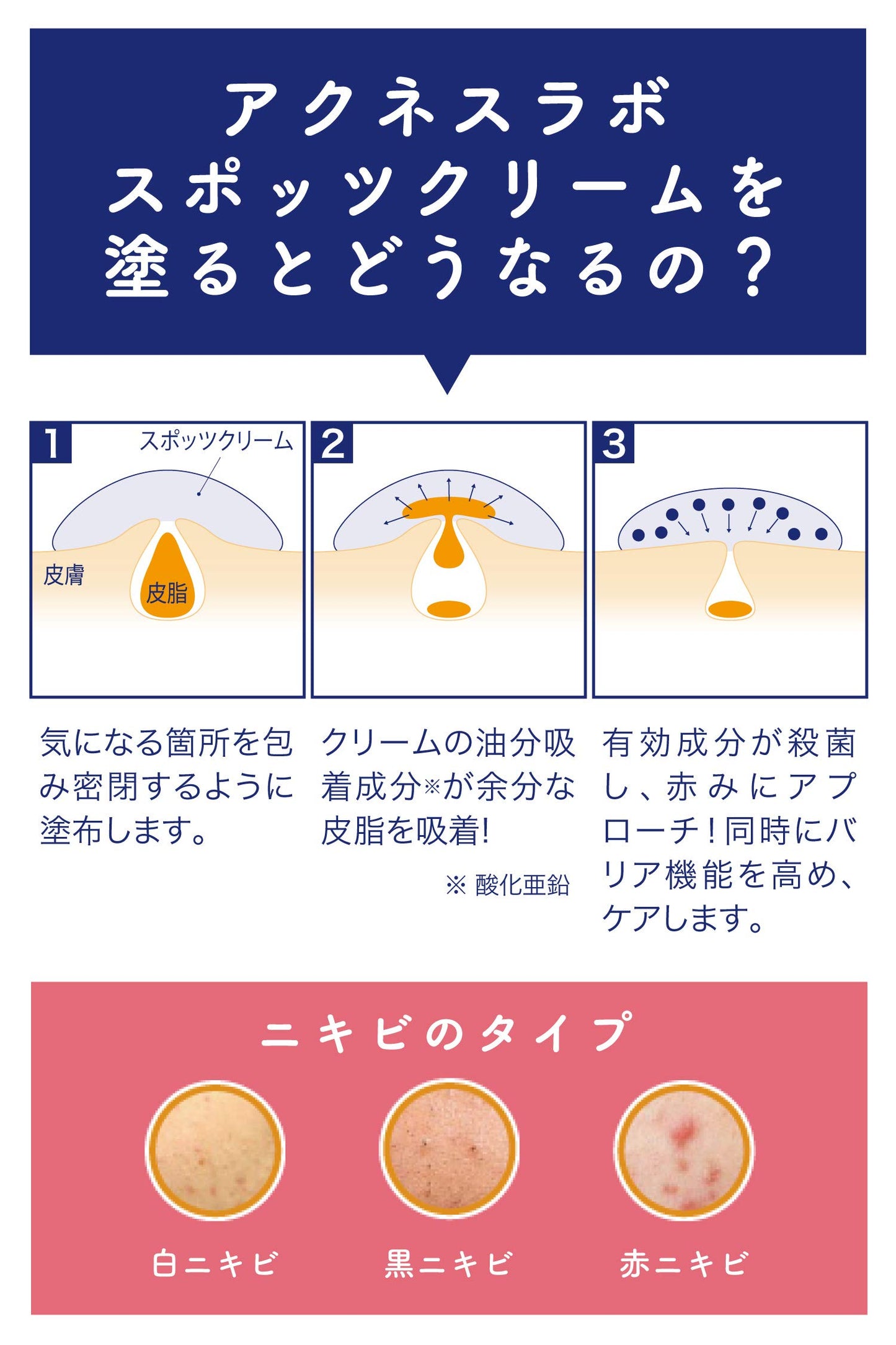 醫藥部外品 藥用 痘痘 霜 夜用 點貼 佐料 約 170 次分 7 克 痘痘 保養 無添加 低刺激